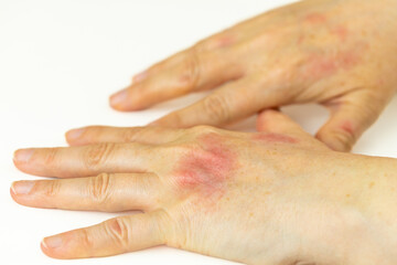 Cracked and burning skin, Red itchy Female hands with blisters. Health concept. Eczema brought from...