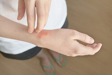 Managing eczema: close-up of skin condition and treatment concepts