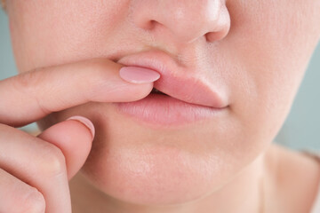 The woman made lip augmentation. The gel went beyond the lip. Migration of the filler into the...