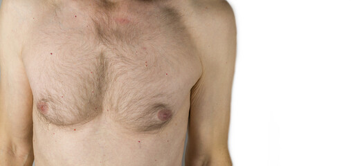 Naklejka premium Cherry angiomas skin disease. Dilated blood vessels on a mature man body
