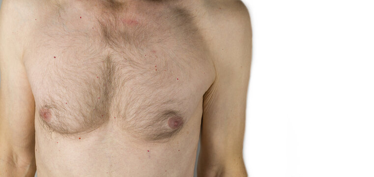 Cherry angiomas skin disease. Dilated blood vessels on a mature man body