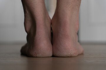Cracked and dry man&rsquo;s heels standing on floor 
