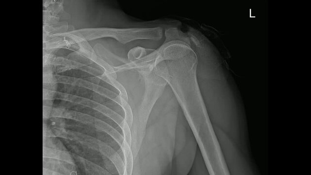 Shoulder AP X-Ray Showing Clavicle and Humeral Head Alignment