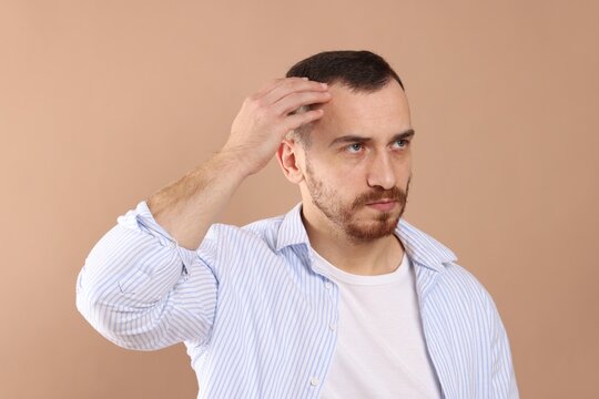 Baldness problem. Man with receding hairline on beige background