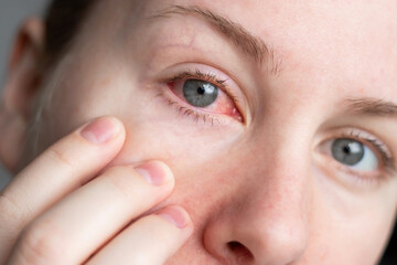 Close up of female face with one red eye suffering from infection conjunctivitis