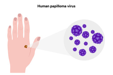 Human papilloma virus in zoom view on human hand. Hpv in human