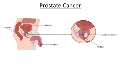 Fototapeta premium Prostate Cancer vector illustration. Male reproductive system