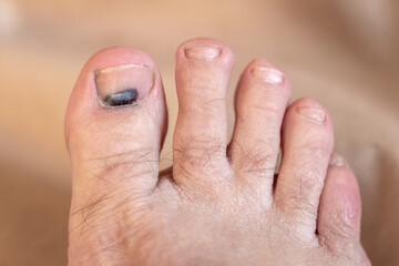 Close-up image of a human foot with a bruise under the big toe nail on a blurred beige background