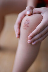 Wounded knee of the child. Abrasion on the lap of baby close-up after the fall. A scratch with blood. Body trauma. 
