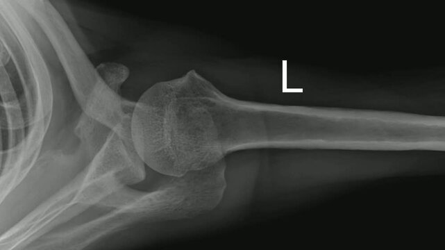 Axial Shoulder X-Ray Demonstrating Glenohumeral Joint Anatomy