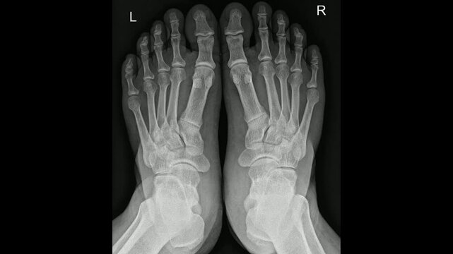 Bilateral Foot Radiograph Video Showing Bone and Joint 