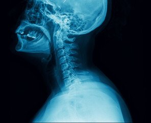 Lateral X-ray of skull and cervical spine with medical imaging detail. Head and neck Xray film with visible bone structure. Diagnostics, internal anatomy and health assessment concept