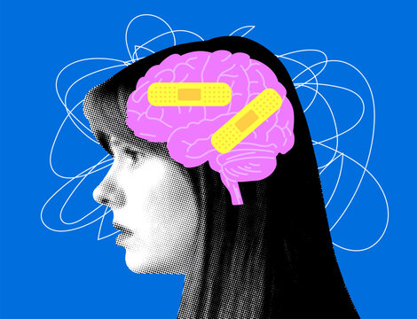 Modern collage with female head and brain covered with plaster bandage. Concept of mental health, dementia, headache. Head trauma, amnesia illustration