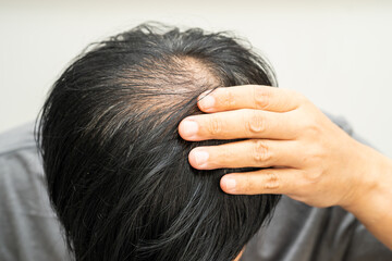 Fototapeta premium Bald head in man, hair loss treatment health problem.