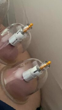 coppettazione, cupping therapy