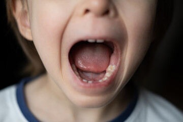 Portrait of little boy with open mouth without one front milk tooth. Loss of baby primary teeth....