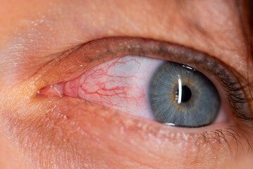 Red eye displaying burst blood vessels from subconjunctival hemorrhage and conjunctivitis,...