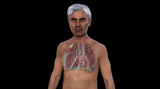 Lung miliary tuberculosis in a middle-aged Caucasian man, 3D animation showing numerous small nodules throughout lung tissue.