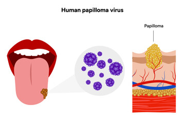 Human papillomavirus on tongue. Medical screening illustration
