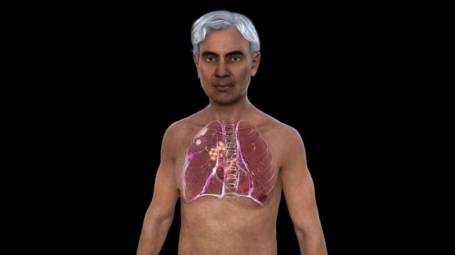 Primary lung tuberculosis in a man with the Ranke complex, 3D animation showing pulmonary lesion and mediastinal lymphadenitis with calcification.