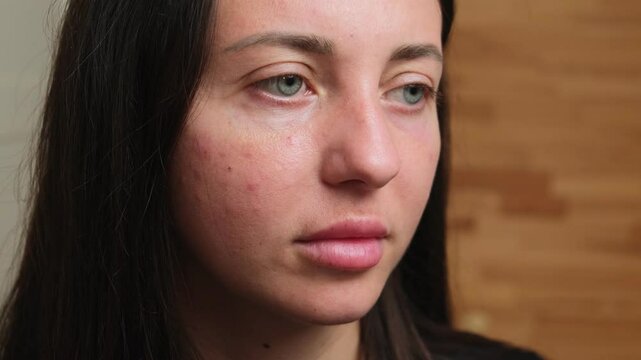 Young woman face with redness on cheeks, close-up. Challenges of sensitive skin and vascular issues, highlighting skincare treatments and dermatological solutions. Allergic red rashes.