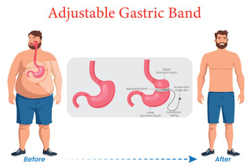 Adjustable Gastric Band Before & After Transformation