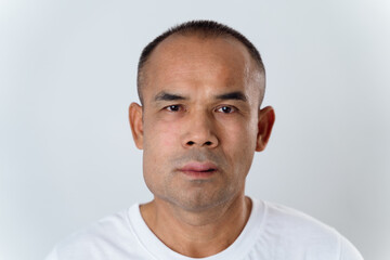 The man has facial swelling due to an allergic reaction to triggers such as insect bites stings.