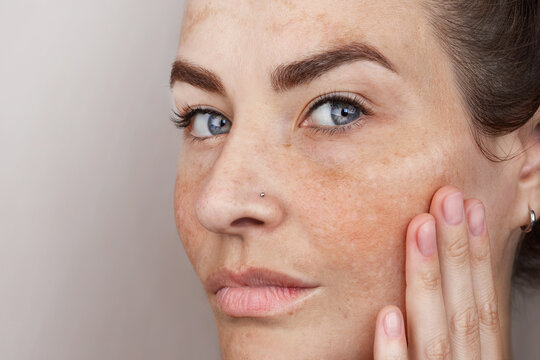 Close up caucasian woman's face with freckles or age spots. Age spots on the face. Woman with blue eyes looks at camera, melasma