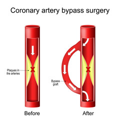 Coronary artery bypass graft. Heart surgery