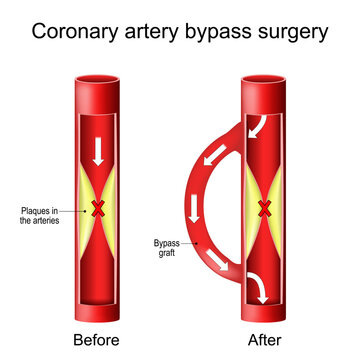 Coronary artery bypass graft. Heart surgery