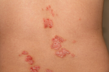 Fototapeta premium Psoriasis skin condition showing red, scaly patches on back during a clinical examination