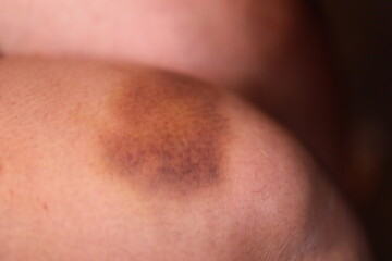 Fototapeta premium A close-up shot of a person's arm with a noticeable bruise, suitable for use in medical or injury-related contexts.