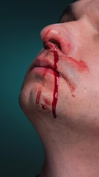 vertical video Man suffering nosebleed with blood dripping on chin
