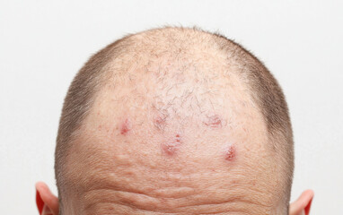 Fototapeta premium Thickened and scaly skin on forehead with visible lesions, indicating skin condition. image captures texture and appearance clearly