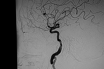 Medical themes: angiography that shows an aneurysm in the anterior cerebral artery