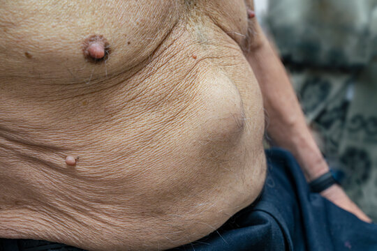 Medical themes: Mature man with an abdominal eventration and  supernumerary nipple.