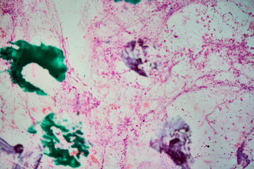 Cytology showing squamous cell carcinoma from bronchial lavage