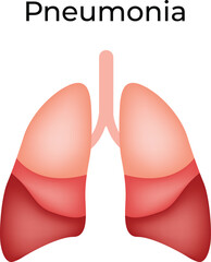 Pneumonia Lung Abscess Vector Illustration