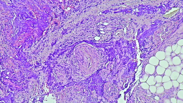 Photomicrograph of pyogenic granuloma, in digiti 3 manus dextra tumor under microscope in anatomical pathology laboratory