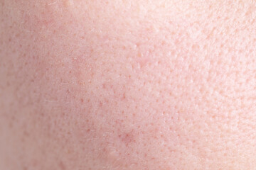 Fototapeta premium Texture of skin with enlarged pores as background, closeup
