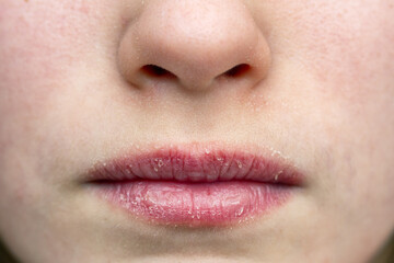 Close up of chapped and dry lips of a little girl