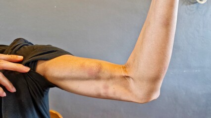 Bruise and pain on the athlete woman biceps.