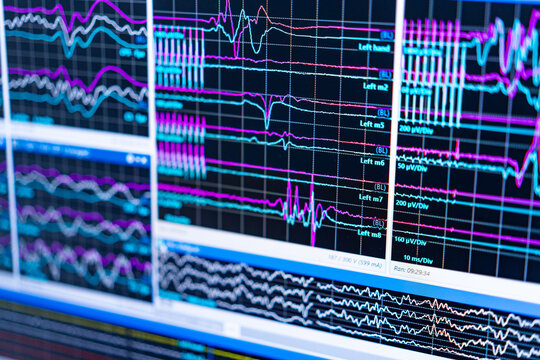 EEG brain wave pattern analysis. Multiple brain wave patterns are displayed on screens, showing electrical activity recorded during an EEG session.