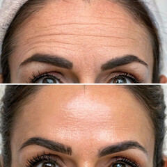 Caucasian Woman's Forehead, Before and After Aesthetic Beauty Cosmetic Treatments with Removed Skin Wrinkles