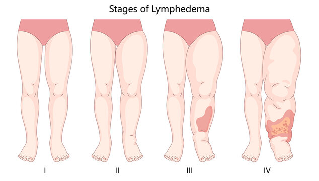four stages of lymphedema, depicting progressive leg swelling, skin changes, and fluid retention due to lymphatic dysfunction diagram hand drawn raster illustration. Medical science educational
