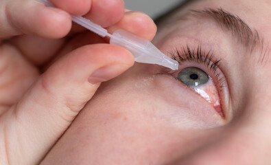 Close up of a woman applying eyedrops on red infected eye with conjunctivitis at home