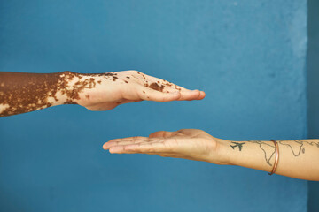 Hand of a man with Vitiligo and a white woman hand against blue wall