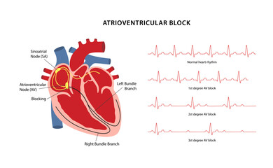 Atrioventricular block. Сardiac conduction system diagram with main captions. Cardiograms of three degrees of AV block. Vector illustration in flat style isolated on white background