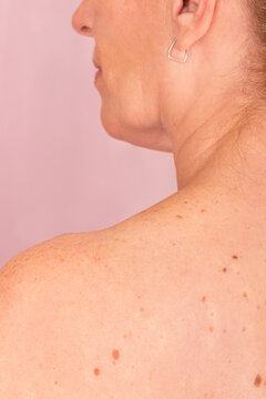 Raising Awareness for Skin Cancer Prevention
