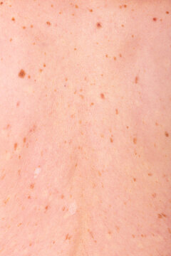 Close-up of Skin with Freckles for Cancer Awareness Theme